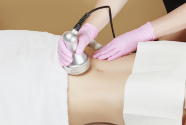 Ultrasound Cavitation